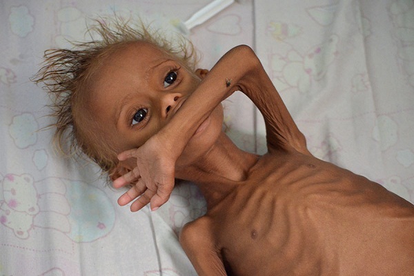 Millions of Yemenis on Verge of Starvation as Saudi Aggression Continues